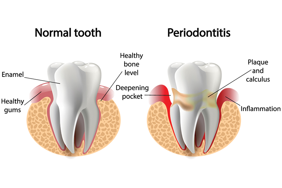 Nha-Khoa-Thien-Bao-Dental-Clinic-Periodontics-02