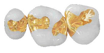 Nha-Khoa-Thien-Bao-Inlay-Onlay-and-Dental-Crown-05