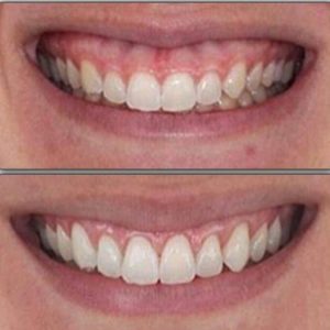 NhaKhoa-Thien-Bao-Dental-Clinic-Gum-Surgery-03