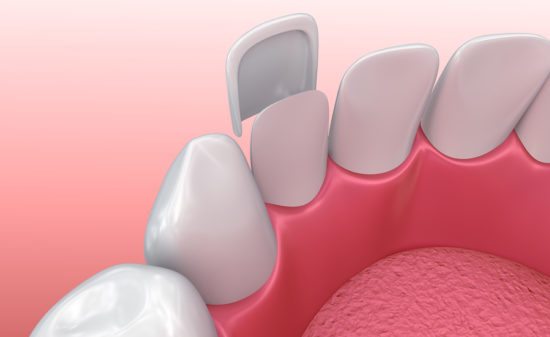 Dental Veneers: Porcelain Veneer installation Procedure. 3D illustration