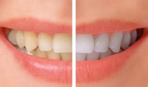 Teeth-Whitening-before-after-NhaKhoaThienBao
