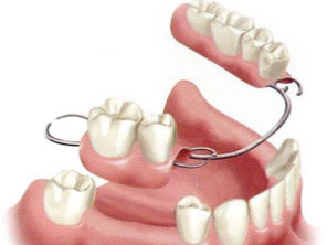 Nha-Khoa-Thien-Bao-Dental-Clinic-Removal-Denture-05-300x225