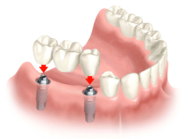 nha-khoa-thien-bao-dental-implant-01