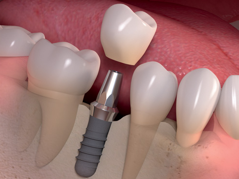 nha-khoa-thien-bao-dental-implant-03-300x225