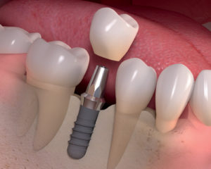 nha-khoa-thien-bao-dental-implant-03